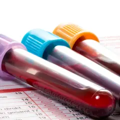 Trzy probówki z krwią na tle formularza badań. Wyniki mogą wskazywać na pdw podwyższone w ciąży.